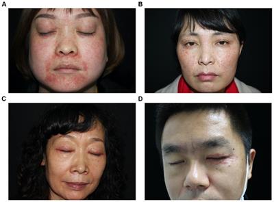 Clinical analysis of lupus miliaris disseminatus faciei: a cross-sectional study and literature review